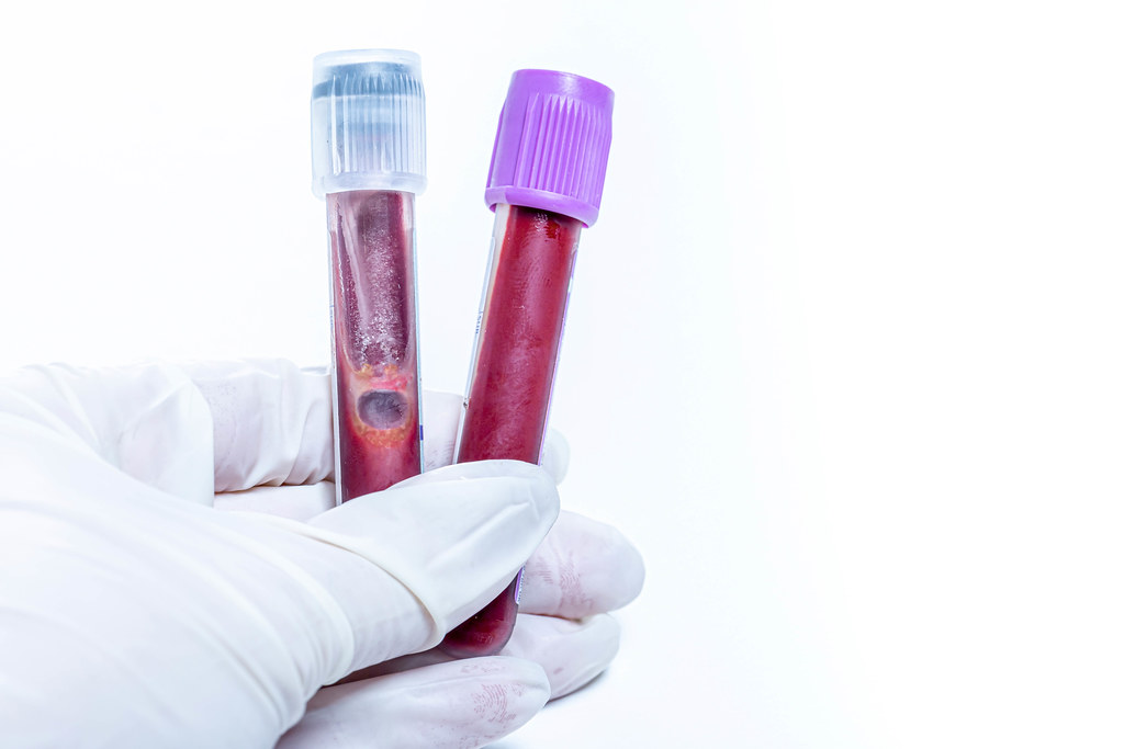 Breakthrough in Early Dementia Detection: Blood Test Shows Promise